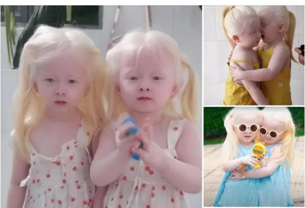 Mesmerizing Beauty: Twin Babies Born with Snow-White Hair Captivate Everyone Who Sees Them