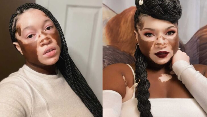 “He Hid a Child for 6 Years, Then I Found Out I Had Vitiligo” – Woman shared her story of how she turned Pain Into Power and Purpose