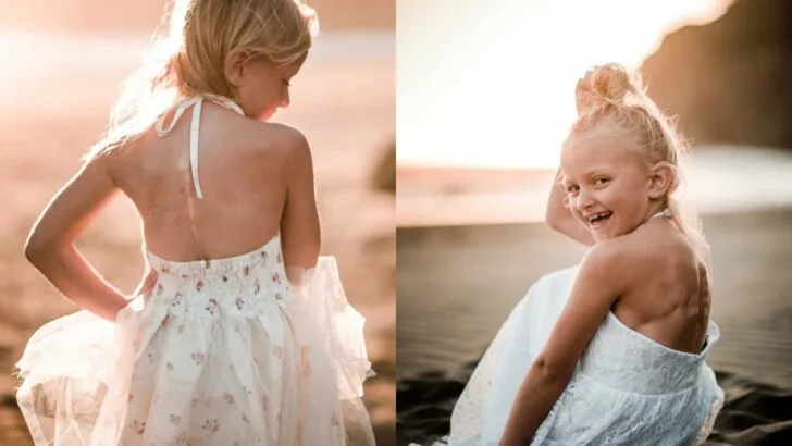 A Boy Told My Daughter Her Scars Were Scary, So I Showed Her Their Beauty Through a Powerful Photo Shoot