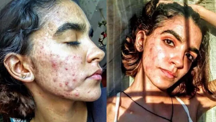 “My Cysts Would Explode”: Teen with Acne Conglobata Embraces Her Skin, Finds Confidence and Resilience Through Pain