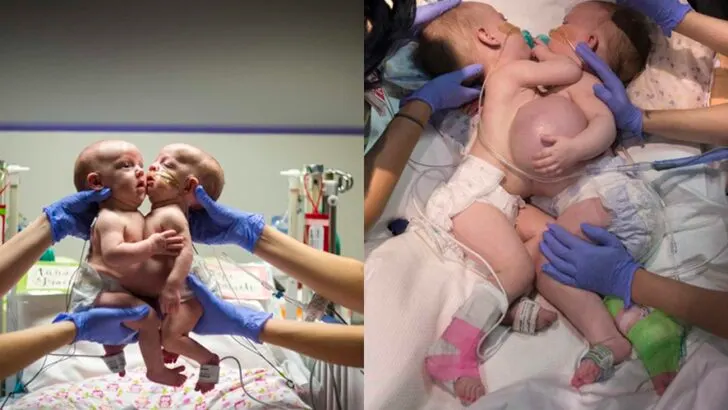 Parents Rejoice After Texas Children’s Hospital Successfully Separates Conjoined Twins Anna Grace and Hope Elizabeth