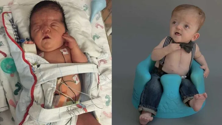 “I Coded, He Wasn’t Breathing”: A Mom’s Life-or-Death Delivery and Her Son’s Rare Apert Syndrome Journey