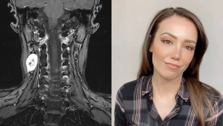 How a Young Woman’s Fight to Be Heard Led to the Discovery of a Rare Nerve Sheath Tumor, Life-Changing Surgery at Mayo Clinic, and the Courage to Inspire Millions